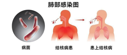 美国向菲律宾提供1.3亿菲币结核病检测及预防工具